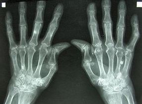 rheumatoid-arthritis